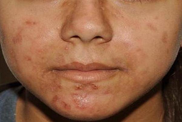 افزایش آکنههای پوستی با مصرف این مواد غذایی پرطرفدار افزایش آکنههای پوستی با مصرف این مواد غذایی پرطرفدار