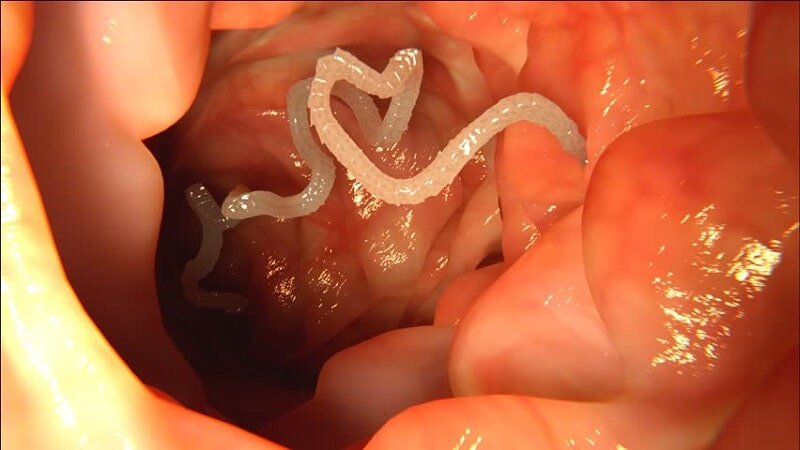 ۱۲ علامت که خبر از وجود انگلها در بدنتان میدهد! چه کار کنیم؟ ۱۲ علامت که خبر از وجود انگلها در بدنتان میدهد! چه کار کنیم؟