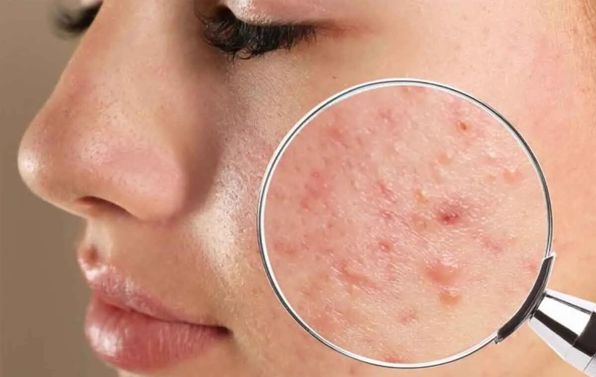 ۵ روش جلوگیری از جوش‌ زدن بعد از بند انداختن صورت