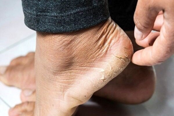 خشکی پاشنه پا را چگونه درمان کنیم؟ | شایع‌ترین دلایل خشکی پاشنه پا