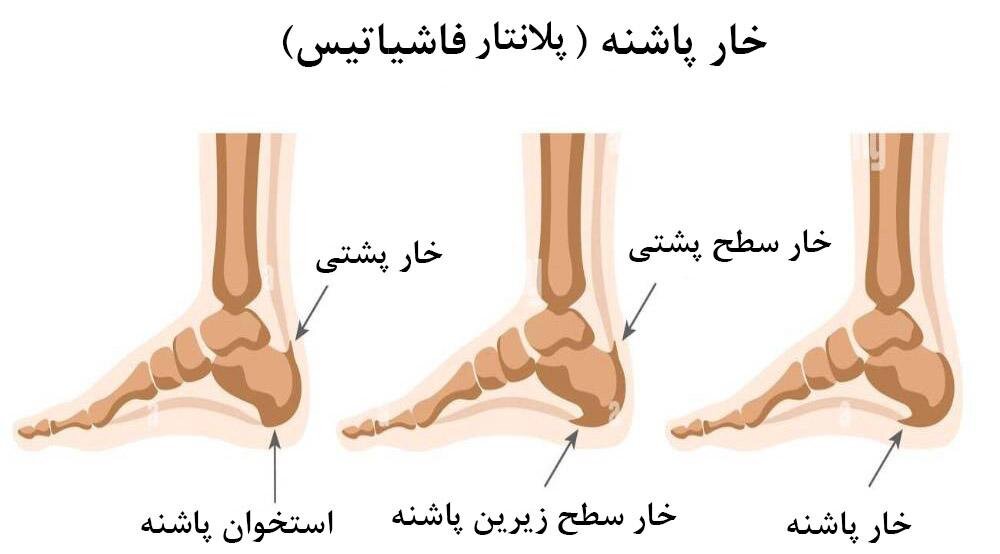 اگر خار پاشنه دارید و از درد آن عاجز شده‌اید، بخوانید