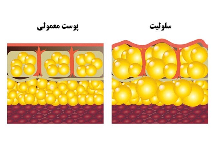 ۵ راه ساده برای درمان سلولیت در خانه ۵ راه ساده برای درمان سلولیت در خانه