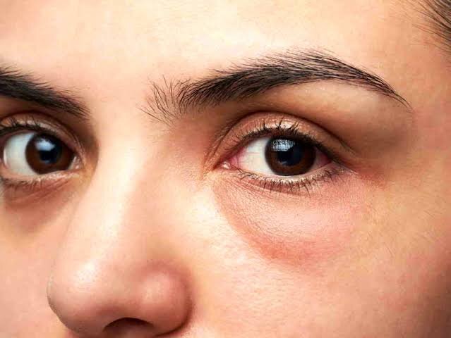 راز چشم‌های شاداب؛ چند راهکار فوری برای رفع پف زیر چشم
