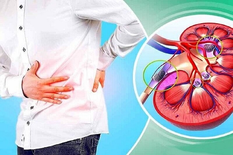 این نوشیدنی را برای فرار از سنگ کلیه نخورید! | ماءالشعیر دشمن سنگ کلیه است یا دوست آن؟ این نوشیدنی را برای فرار از سنگ کلیه نخورید! | ماءالشعیر دشمن سنگ کلیه است یا دوست آن؟