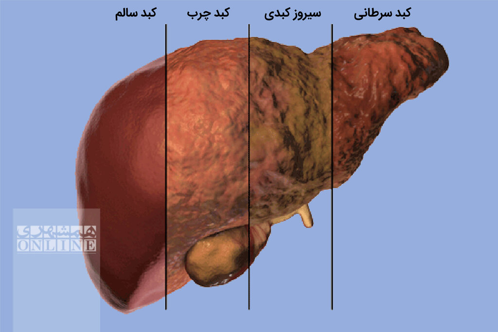 سبزی پرخاصیتی که برای کبد چرب حکم معجزه دارد + روش مصرف